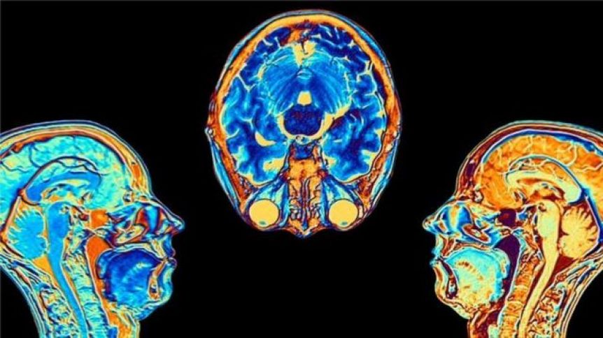 Un estudio detectó que el COVID puede provocar cambios en el cerebro, incluso en casos leves