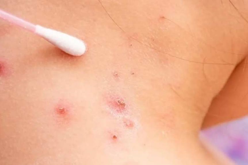 Alerta en Nueva York: decretan emergencia sanitaria por brote de viruela del mono