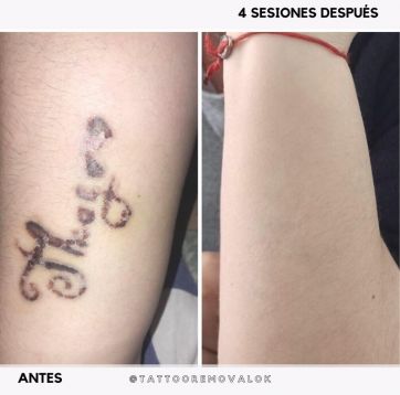 El boom de la eliminación láser de tatuajes