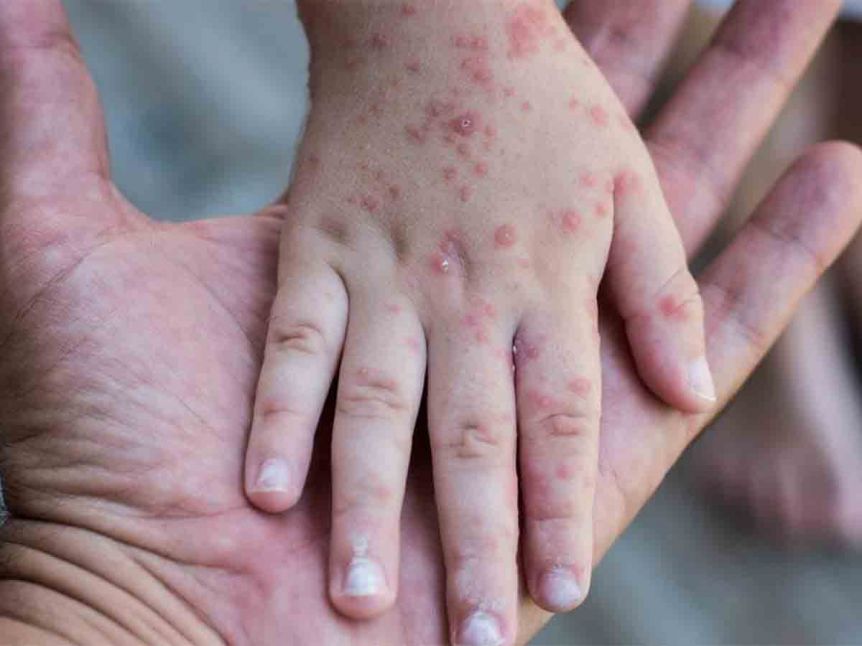 Detectan tres nuevos casos de sarampión en el AMBA y preocupa la falta de vacunación